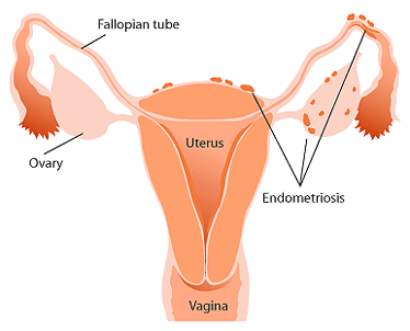 endometriosi1